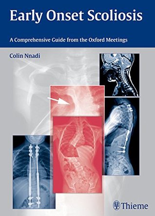 Download Early Onset Scoliosis: A Comprehensive Guide from the Oxford Meetings - Colin Nnadi | ePub